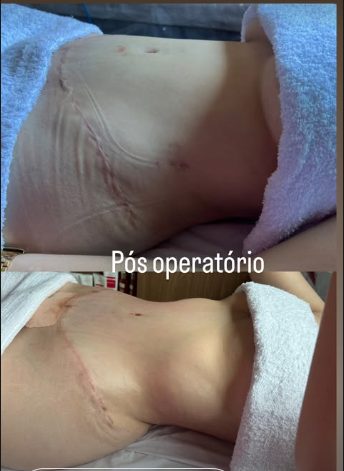 Resultado real pós-operatório — recuperação acompanhada na Neide Estética