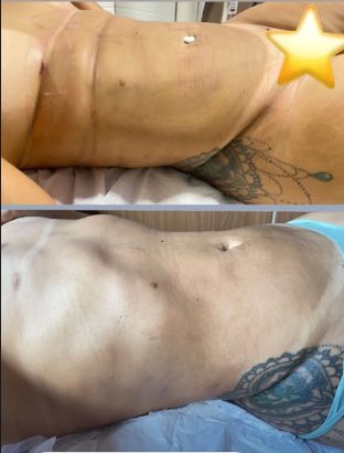 Antes e depois de protocolo corporal — definição abdominal