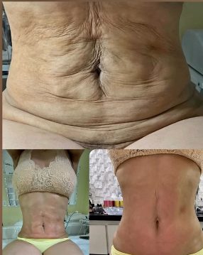 Antes e depois de tratamento para flacidez abdominal