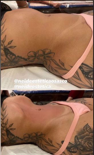 Antes e depois de drenagem e modelagem corporal